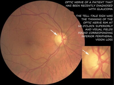 closeup image of retina that has glaucoma