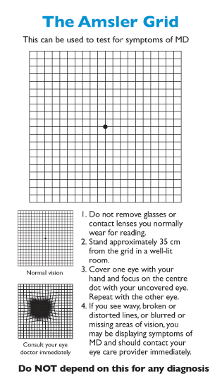 Example of the Amsler Grid test